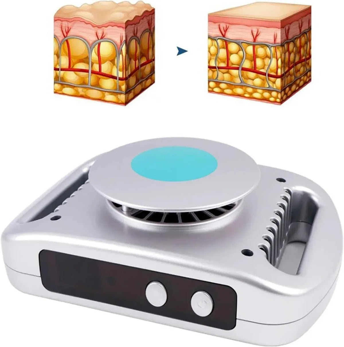 SkyFace Produto Dispositivo de crioterapia, Máquina profissional de criolipolysis, Máquina portátil de remoção de gordura congelante, Máquina de beleza